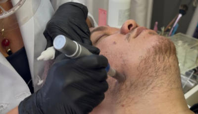 Microagulhamento para fortalecimento e preenchimento da barba